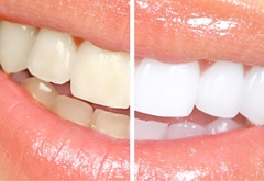 beljenje zob
