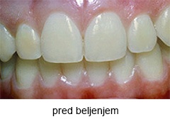 beljenje zob beljenje zob