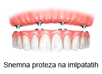 implantanti